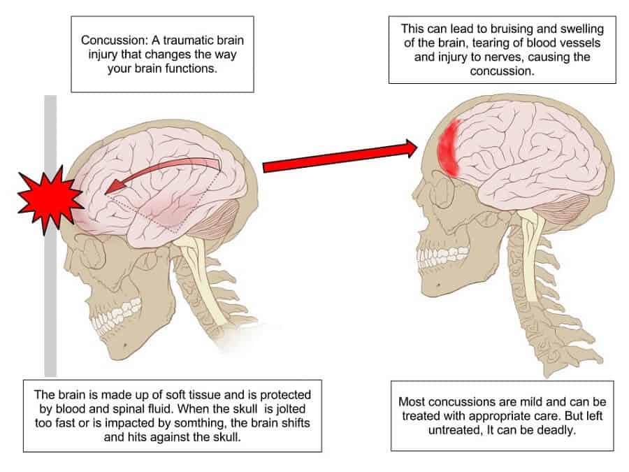 illustration of a skull showing how a concussion takes place